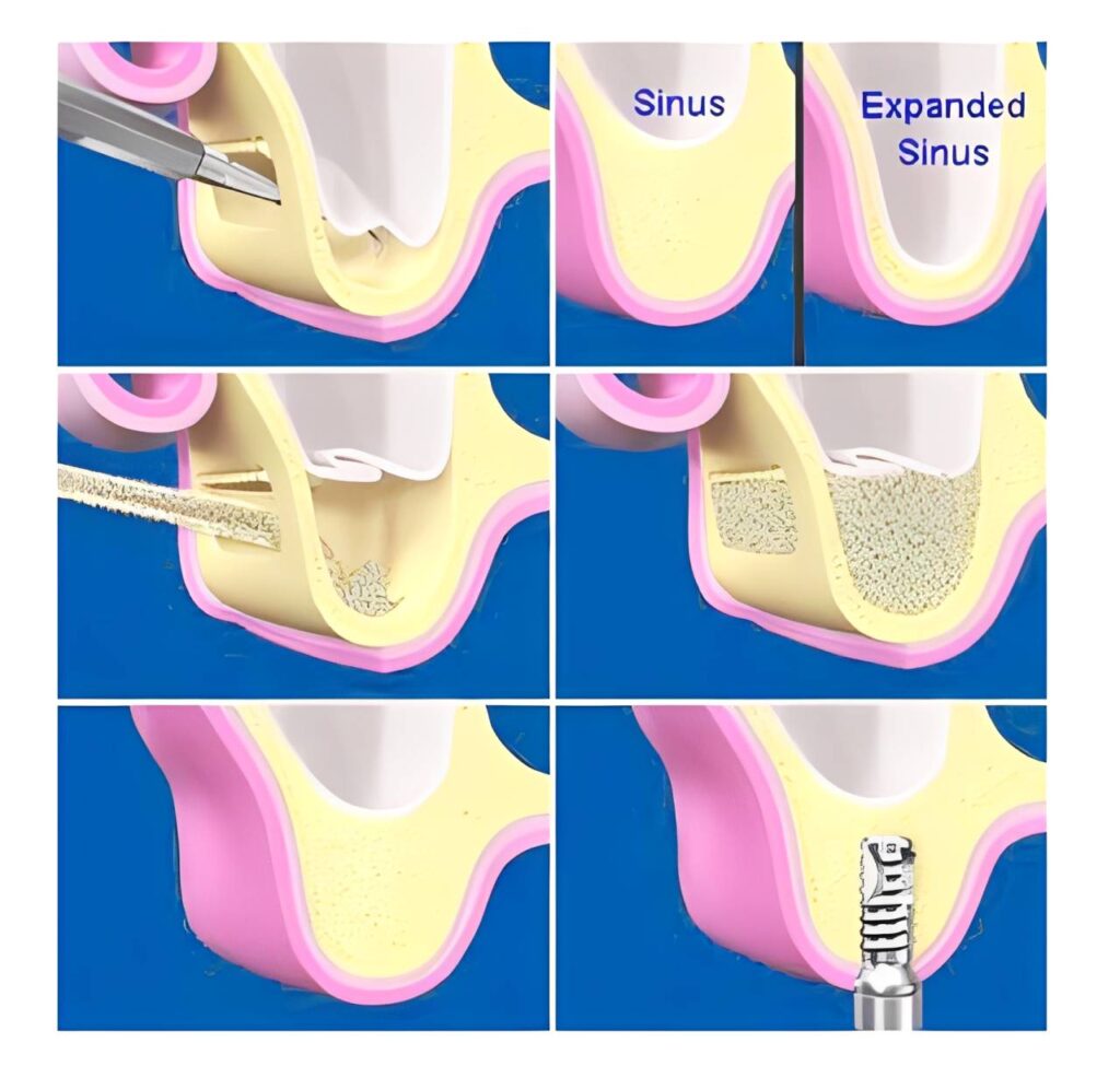 sinus lift