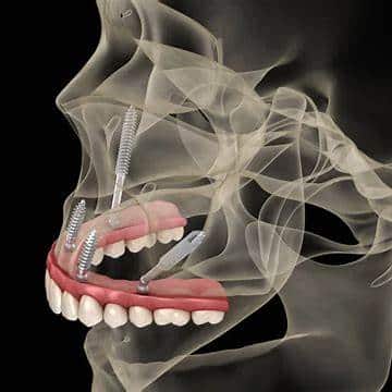 zygomatic implant 1