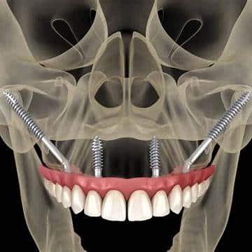 zygomatic implant 2